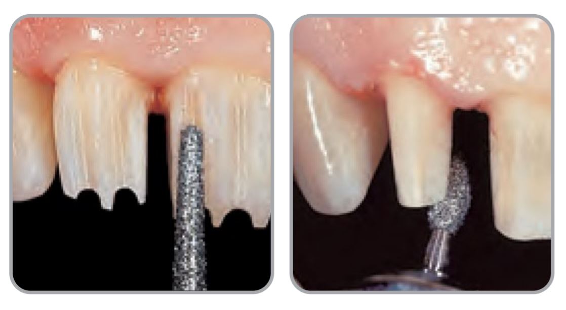 Thumbnail for Intensiv Geneva Prep Set