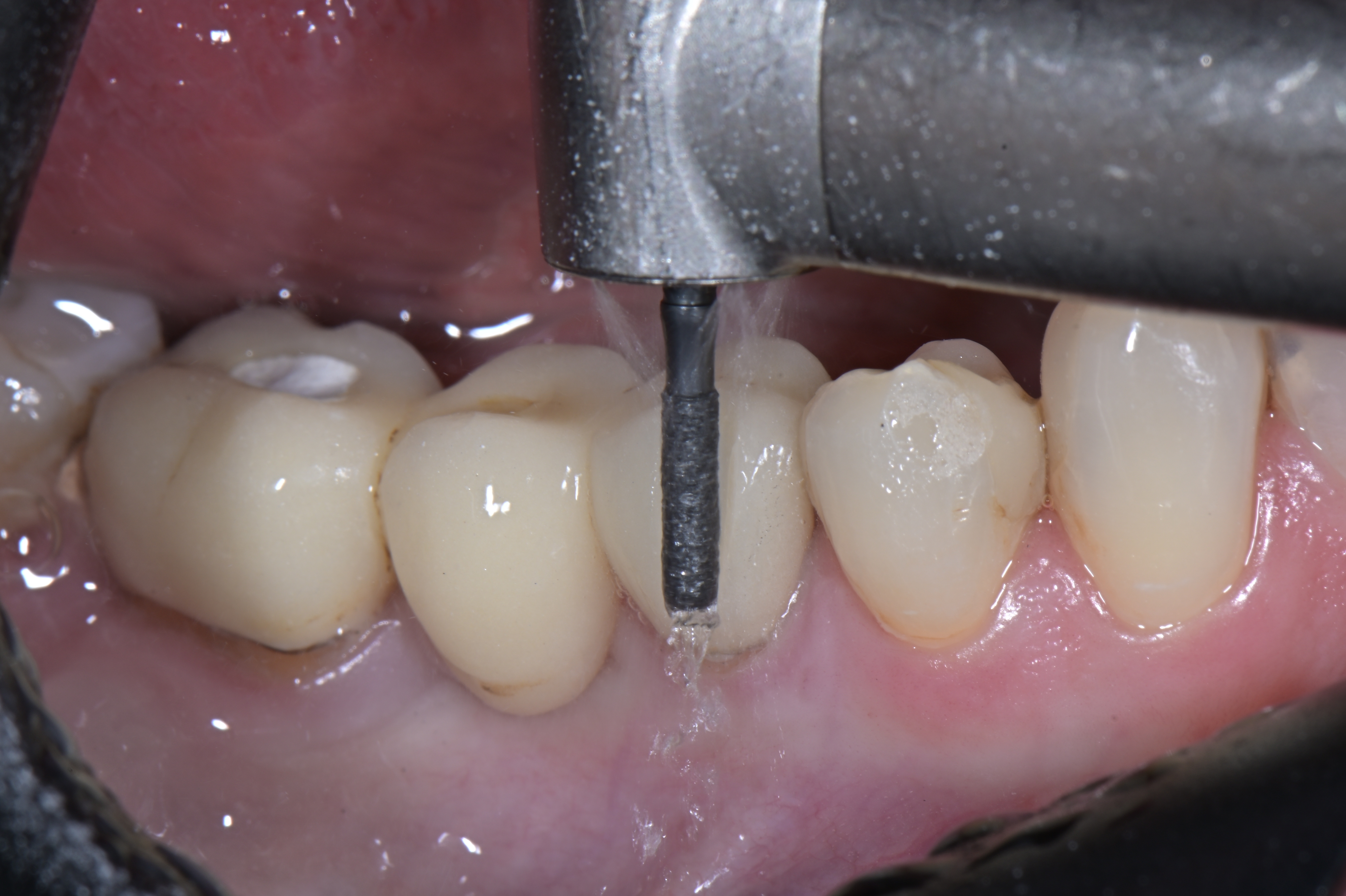 Thumbnail for ZirconCut Prosthetic Set