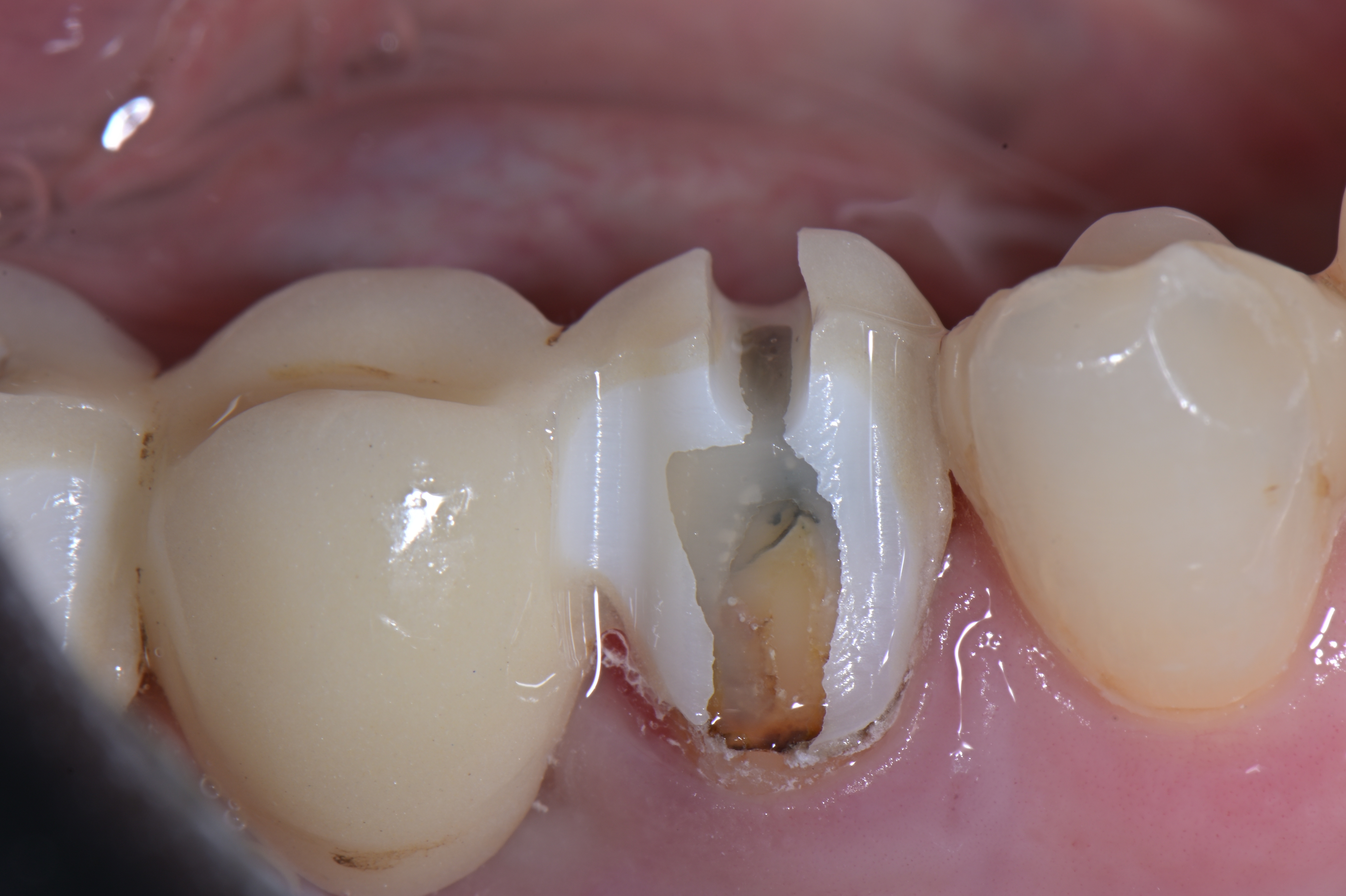 Thumbnail for ZirconCut Prosthetic Set