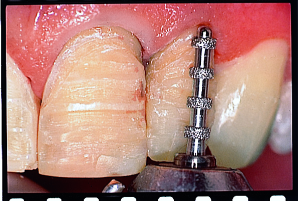 Thumbnail for Intensiv Modular veneer Set