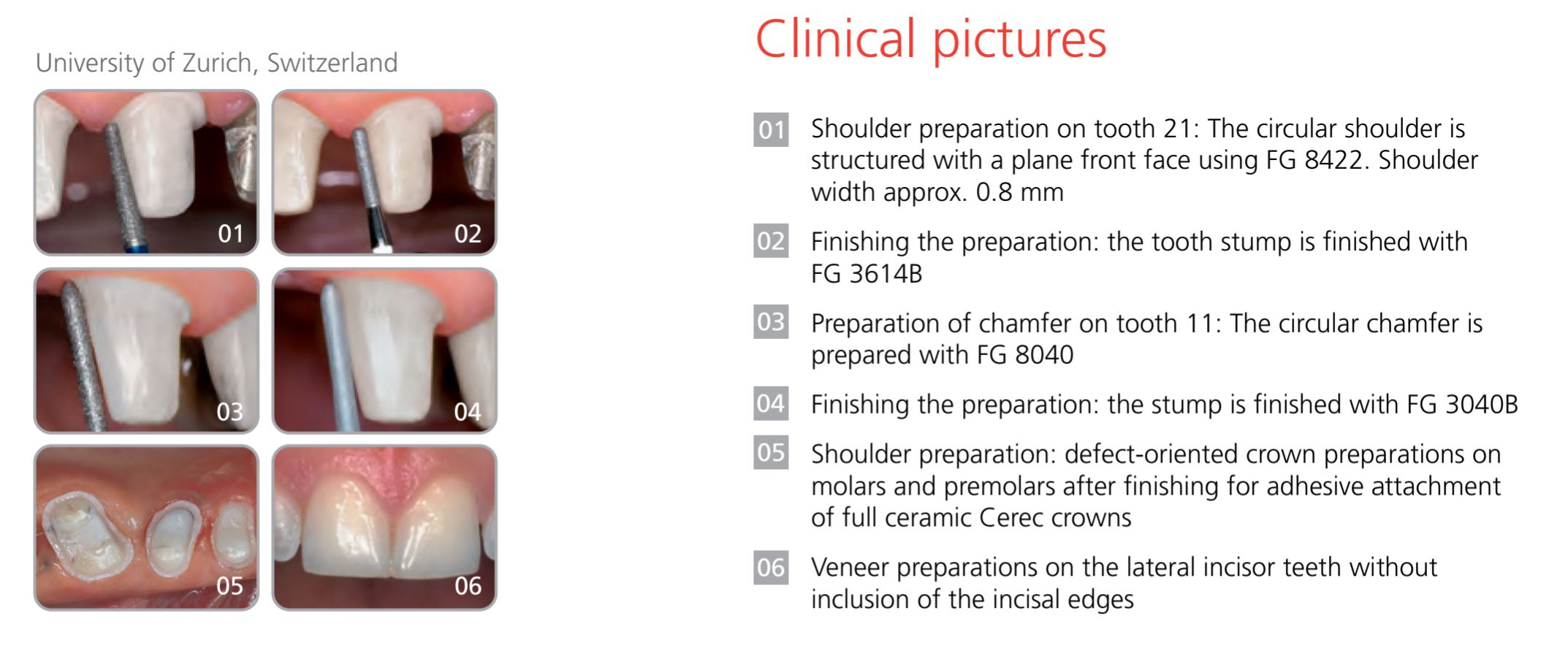 Thumbnail for Intensiv Advanced Prep Set for Cerec Restorations