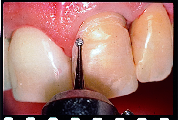 Thumbnail for Intensiv Modular veneer Set