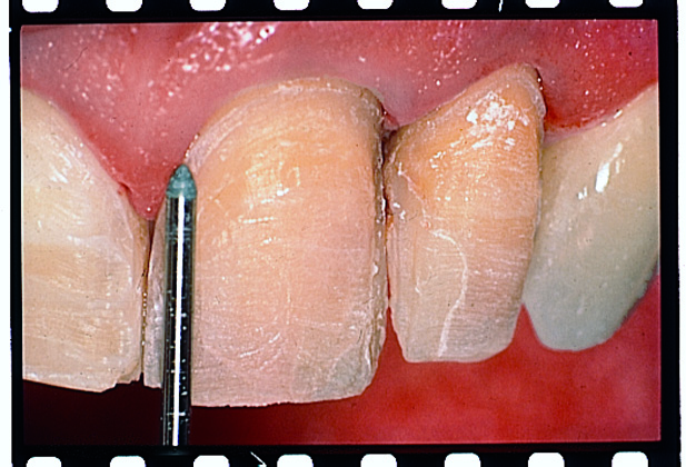 Thumbnail for Intensiv Modular veneer Set